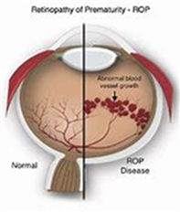 ROP(بيماري شبكيه نوزاد نارس)