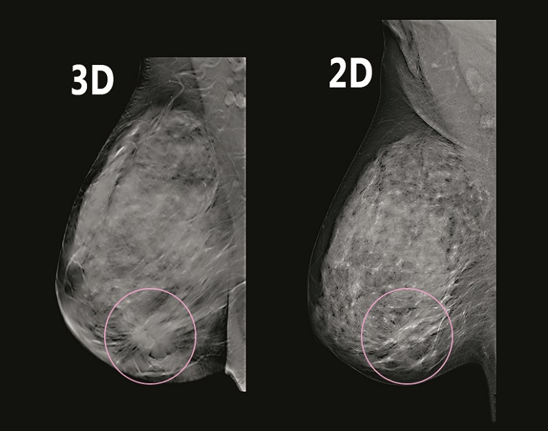 Holigic 3D mammography
